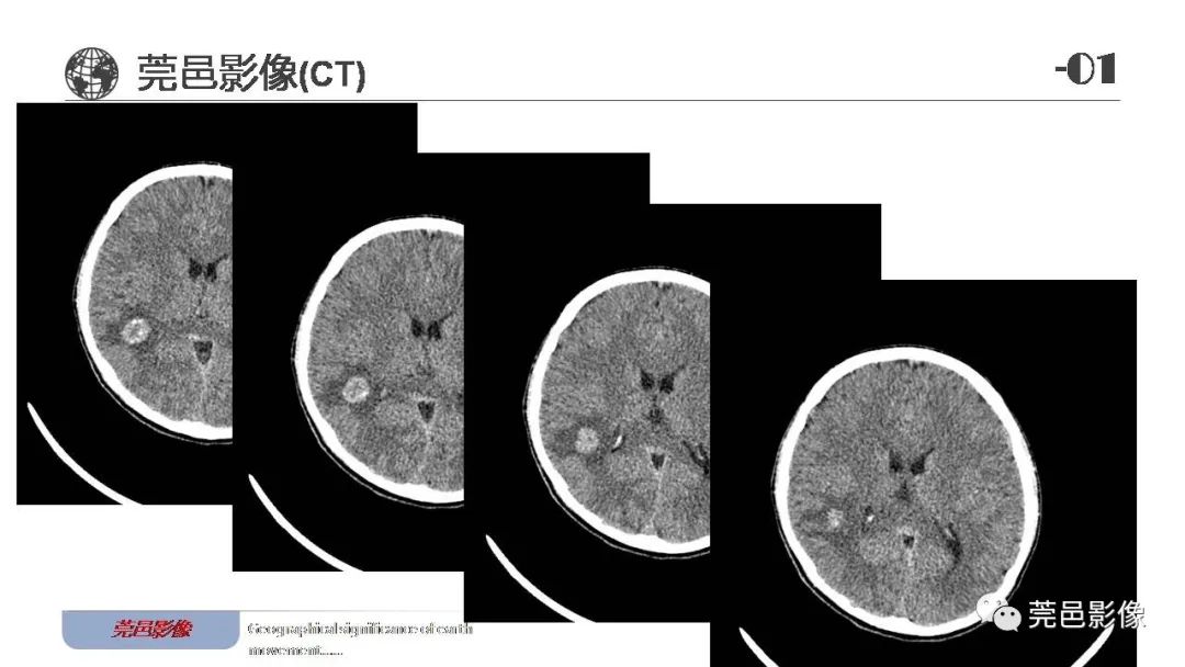 【病例】血管中心性胶质瘤一例分析-4