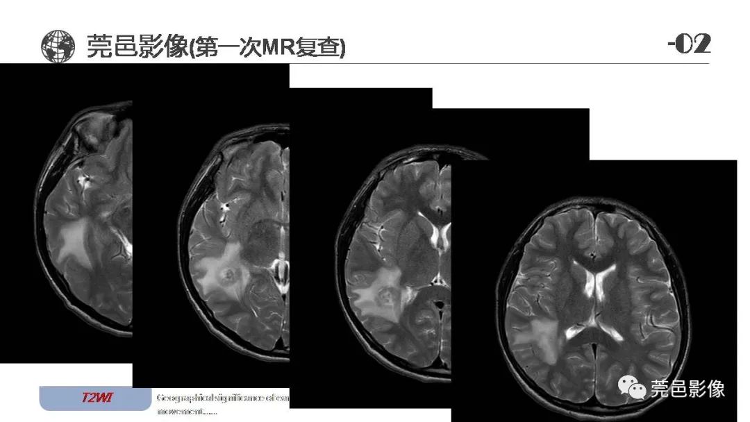 【病例】血管中心性胶质瘤一例分析-6