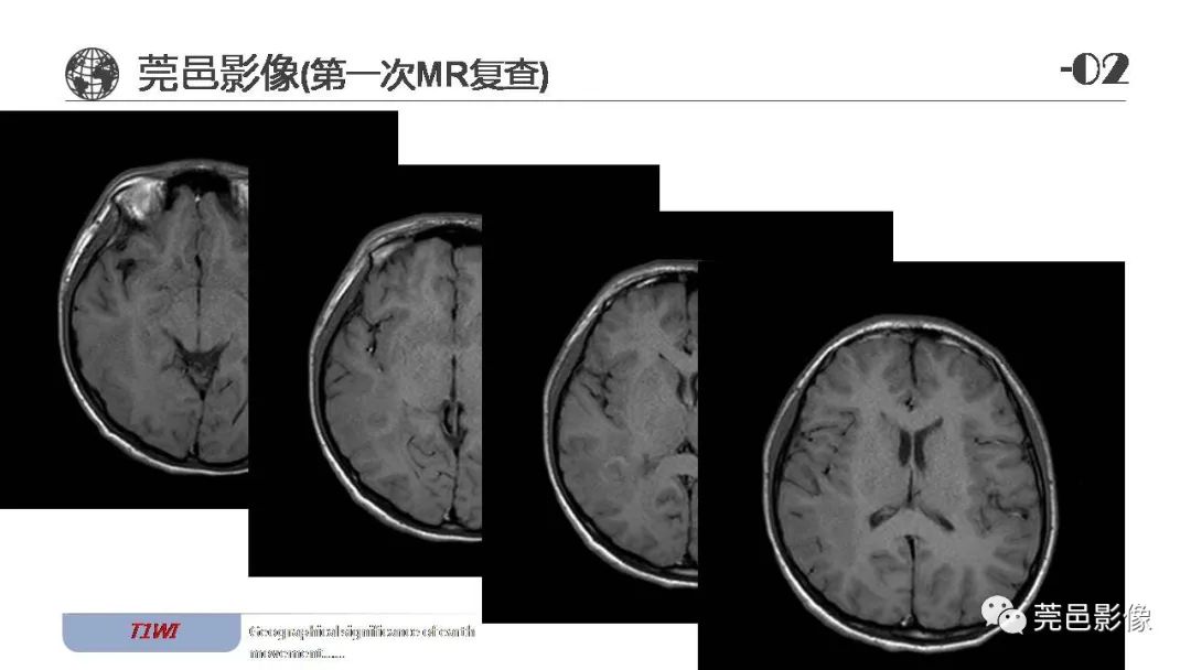 【病例】血管中心性胶质瘤一例分析-7