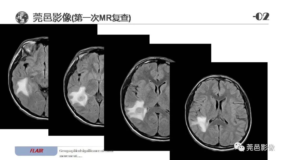 【病例】血管中心性胶质瘤一例分析-8