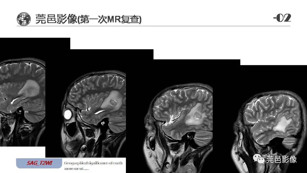 【病例】血管中心性胶质瘤一例分析-9