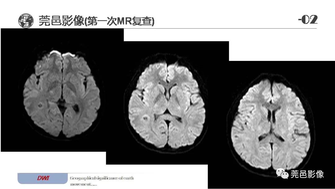 【病例】血管中心性胶质瘤一例分析-10