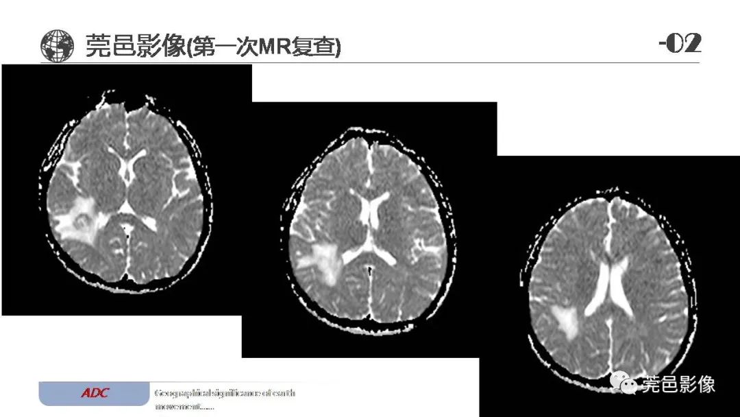 【病例】血管中心性胶质瘤一例分析-11