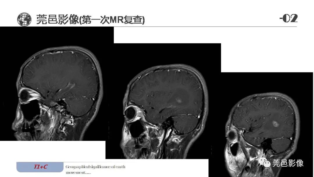 【病例】血管中心性胶质瘤一例分析-12