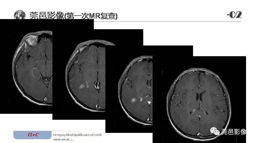 【病例】血管中心性胶质瘤一例分析-13