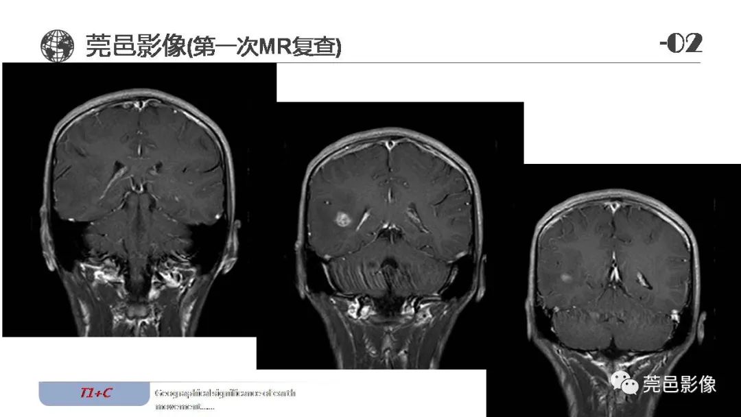 【病例】血管中心性胶质瘤一例分析-14