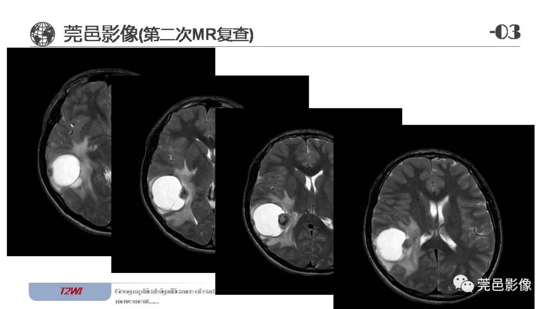 【病例】血管中心性胶质瘤一例分析-16