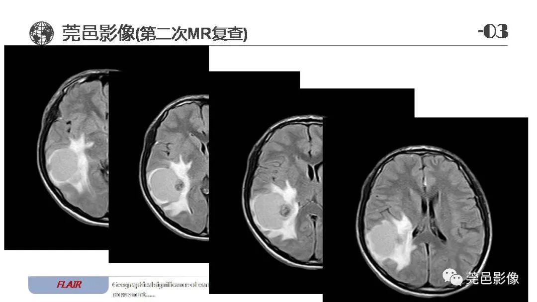 【病例】血管中心性胶质瘤一例分析-18