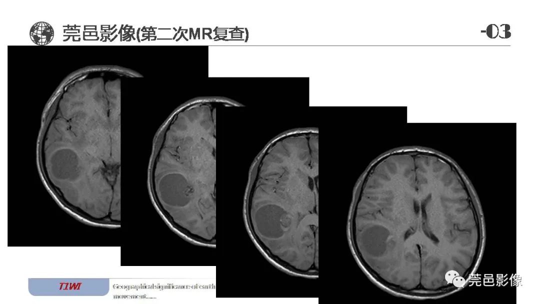 【病例】血管中心性胶质瘤一例分析-17