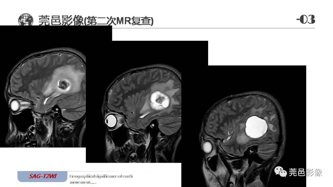 【病例】血管中心性胶质瘤一例分析-19