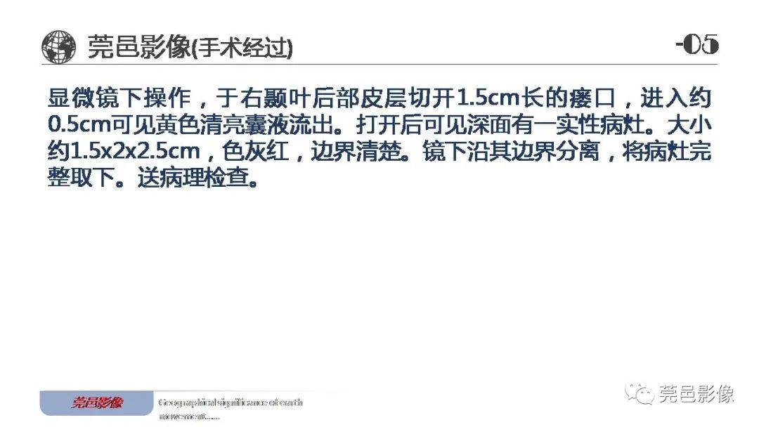 【病例】血管中心性胶质瘤一例分析-22
