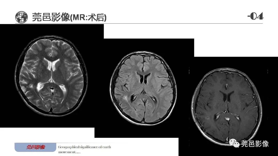 【病例】血管中心性胶质瘤一例分析-21