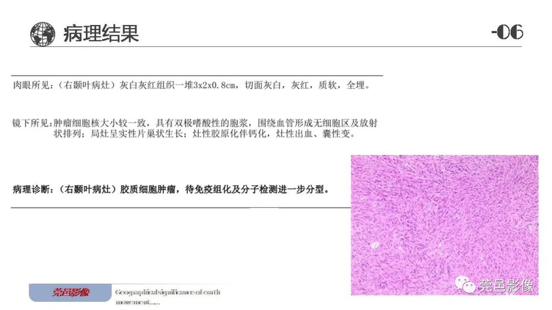 【病例】血管中心性胶质瘤一例分析-23