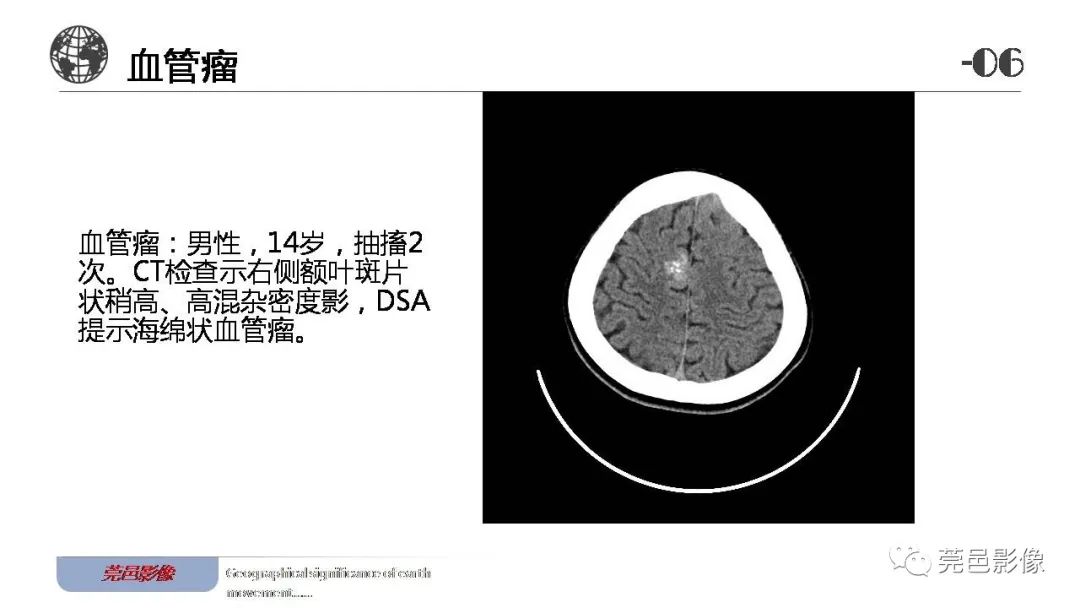 【病例】血管中心性胶质瘤一例分析-29