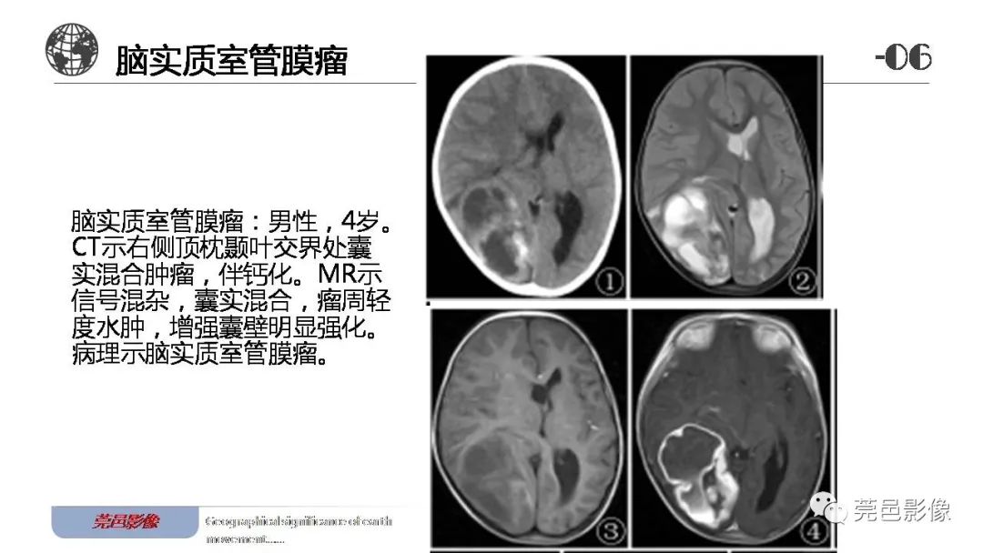 【病例】血管中心性胶质瘤一例分析-30