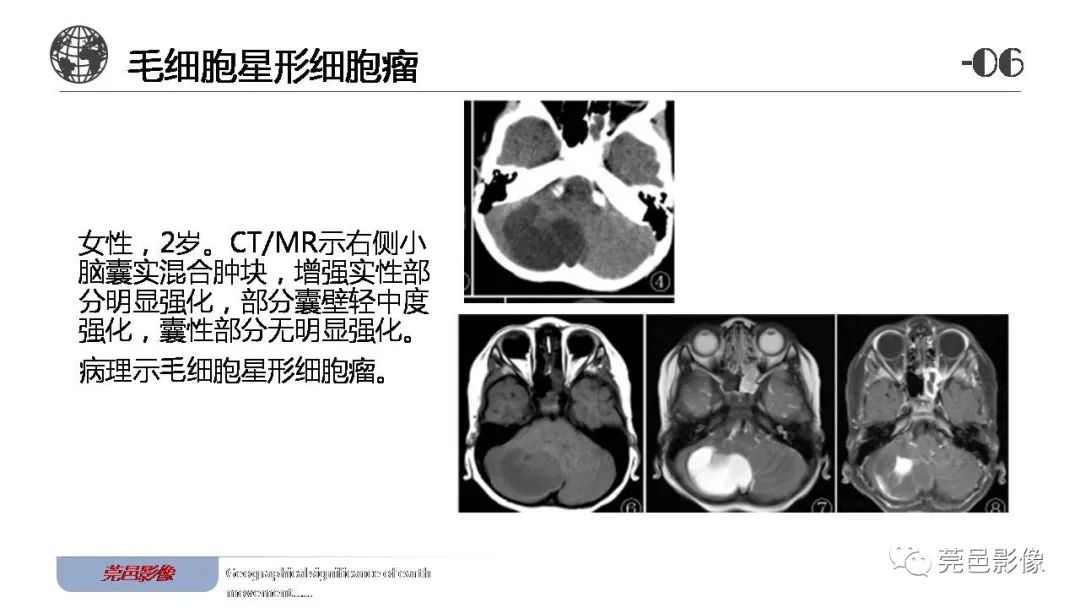 【病例】血管中心性胶质瘤一例分析-31