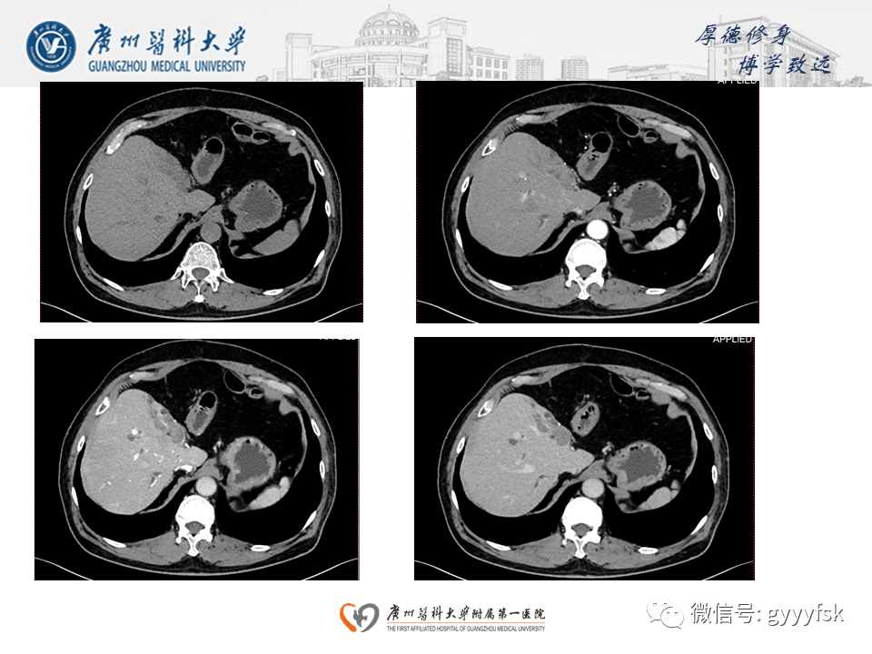 【PPT】胆管导管内乳头状肿瘤(IPNB)-4