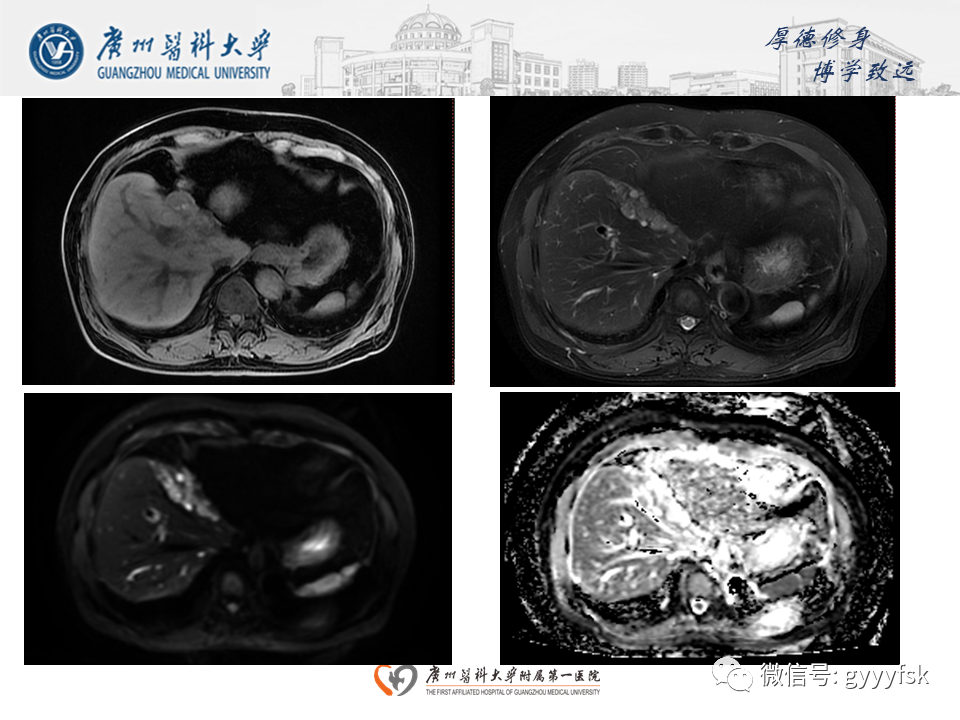 【PPT】胆管导管内乳头状肿瘤(IPNB)-5