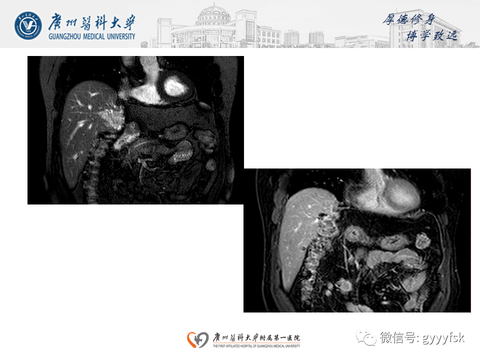 【PPT】胆管导管内乳头状肿瘤(IPNB)-7