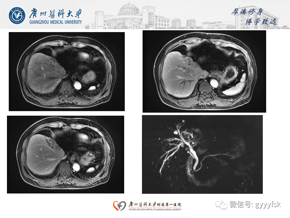 【PPT】胆管导管内乳头状肿瘤(IPNB)-6