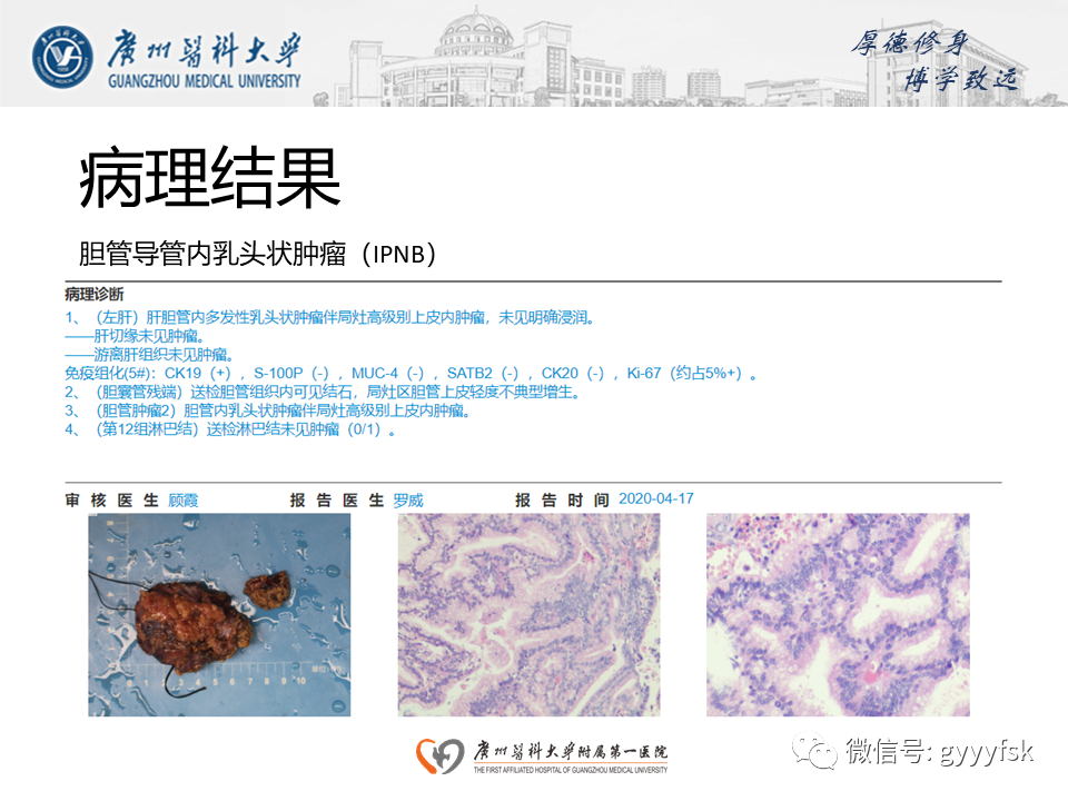 【PPT】胆管导管内乳头状肿瘤(IPNB)-8