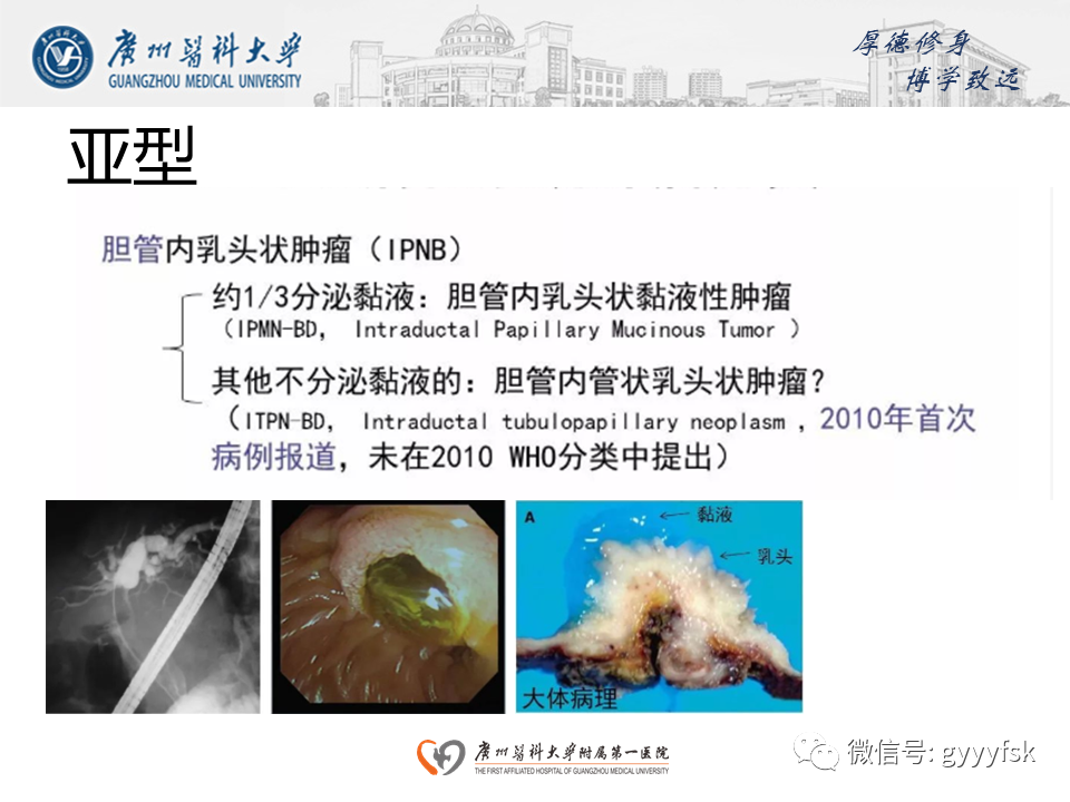 【PPT】胆管导管内乳头状肿瘤(IPNB)-11