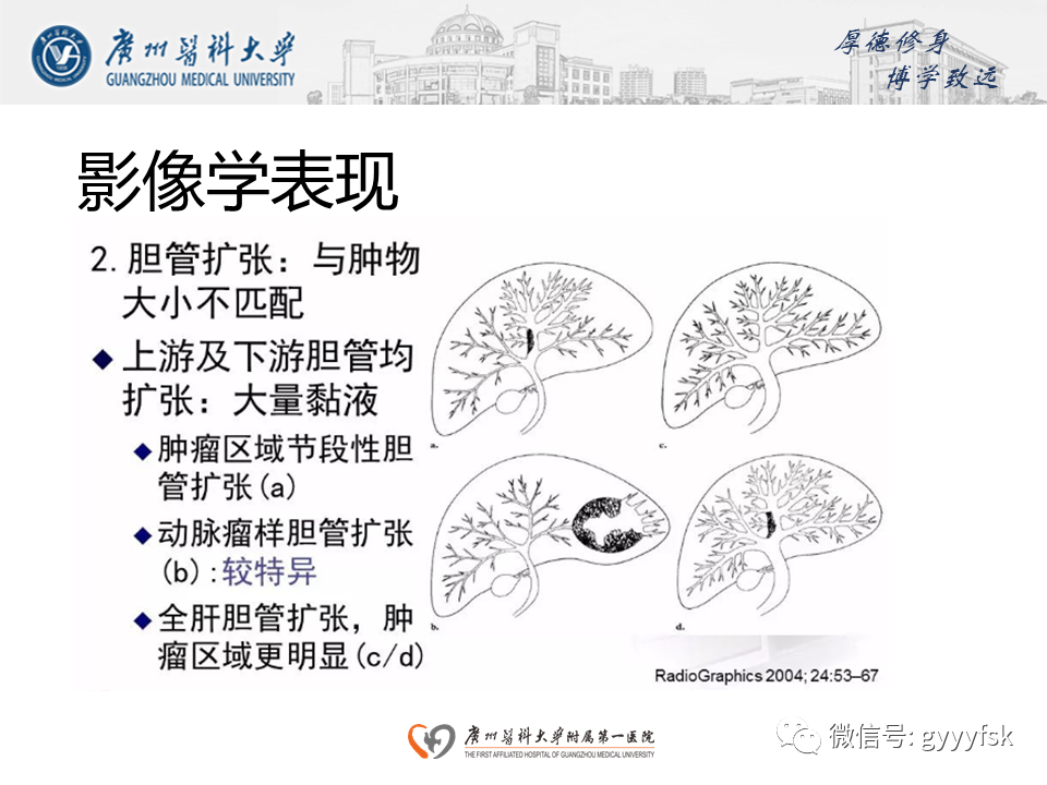 【PPT】胆管导管内乳头状肿瘤(IPNB)-16