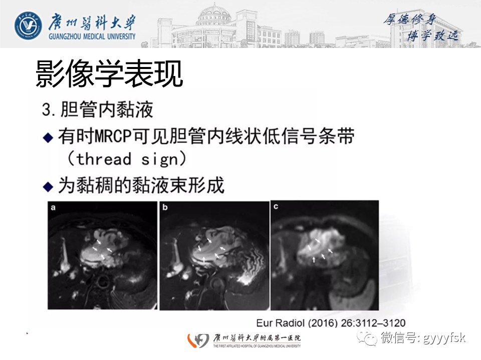 【PPT】胆管导管内乳头状肿瘤(IPNB)-17