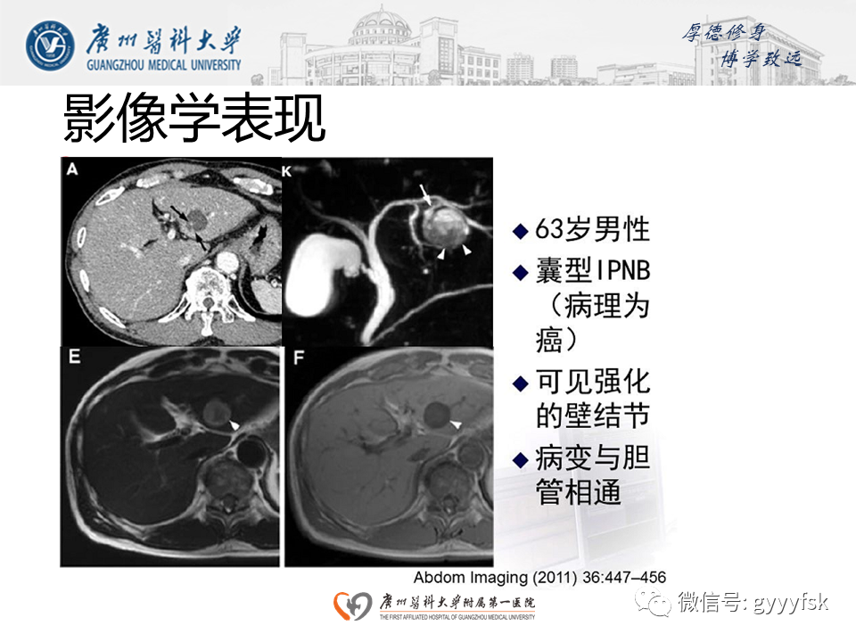 【PPT】胆管导管内乳头状肿瘤(IPNB)-18
