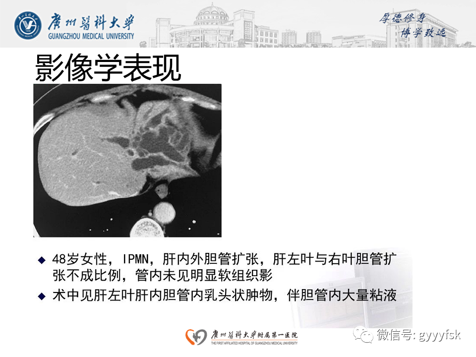 【PPT】胆管导管内乳头状肿瘤(IPNB)-19