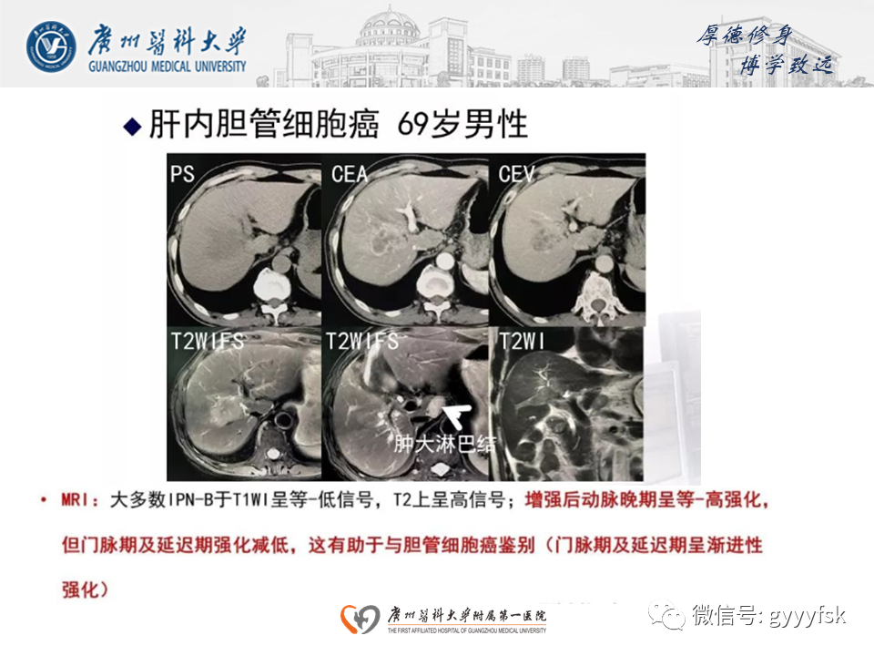 【PPT】胆管导管内乳头状肿瘤(IPNB)-22