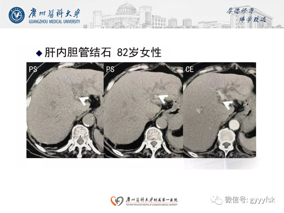 【PPT】胆管导管内乳头状肿瘤(IPNB)-23