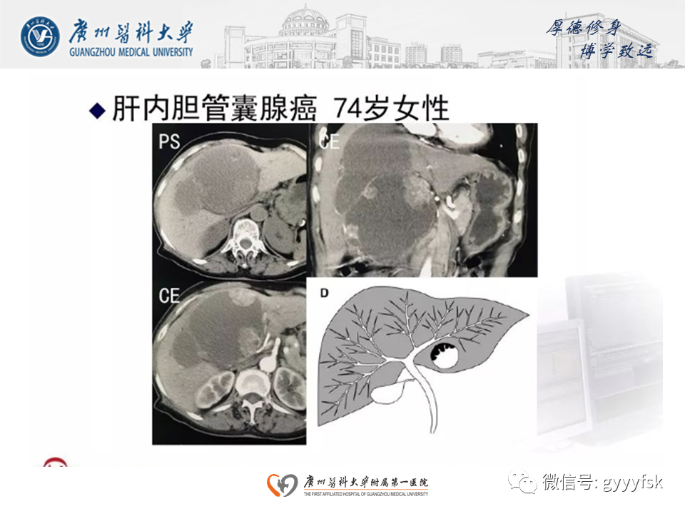 【PPT】胆管导管内乳头状肿瘤(IPNB)-24