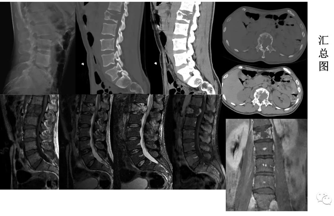 【病例】椎体恶性外周神经鞘瘤 VS 浆细胞瘤-3