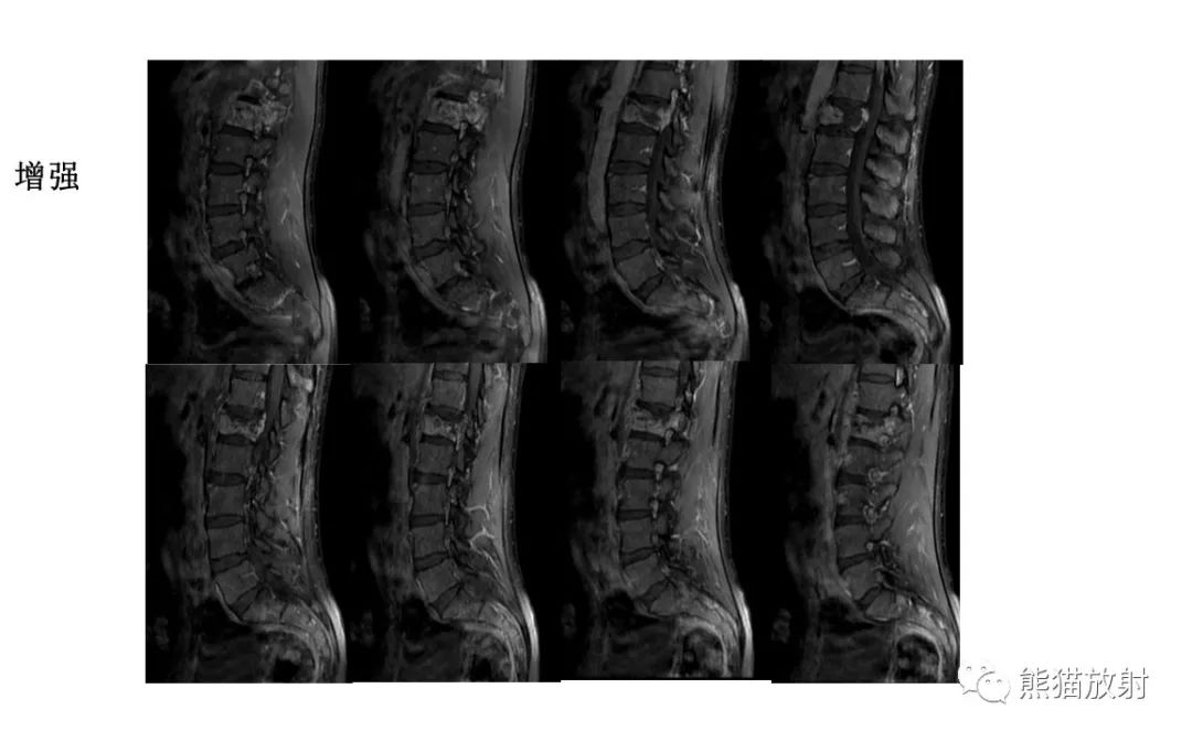 【病例】椎体恶性外周神经鞘瘤 VS 浆细胞瘤-5