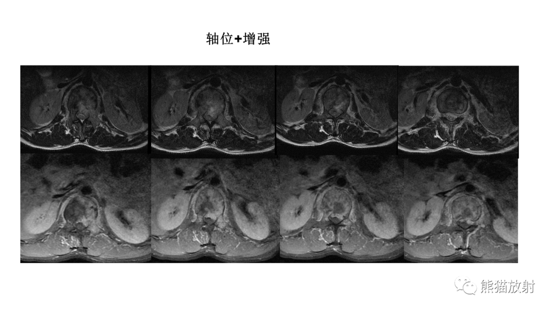 【病例】椎体恶性外周神经鞘瘤 VS 浆细胞瘤-4