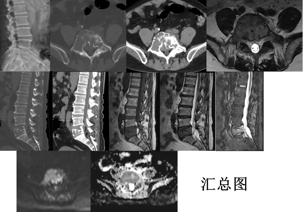 【病例】椎体恶性外周神经鞘瘤 VS 浆细胞瘤-8