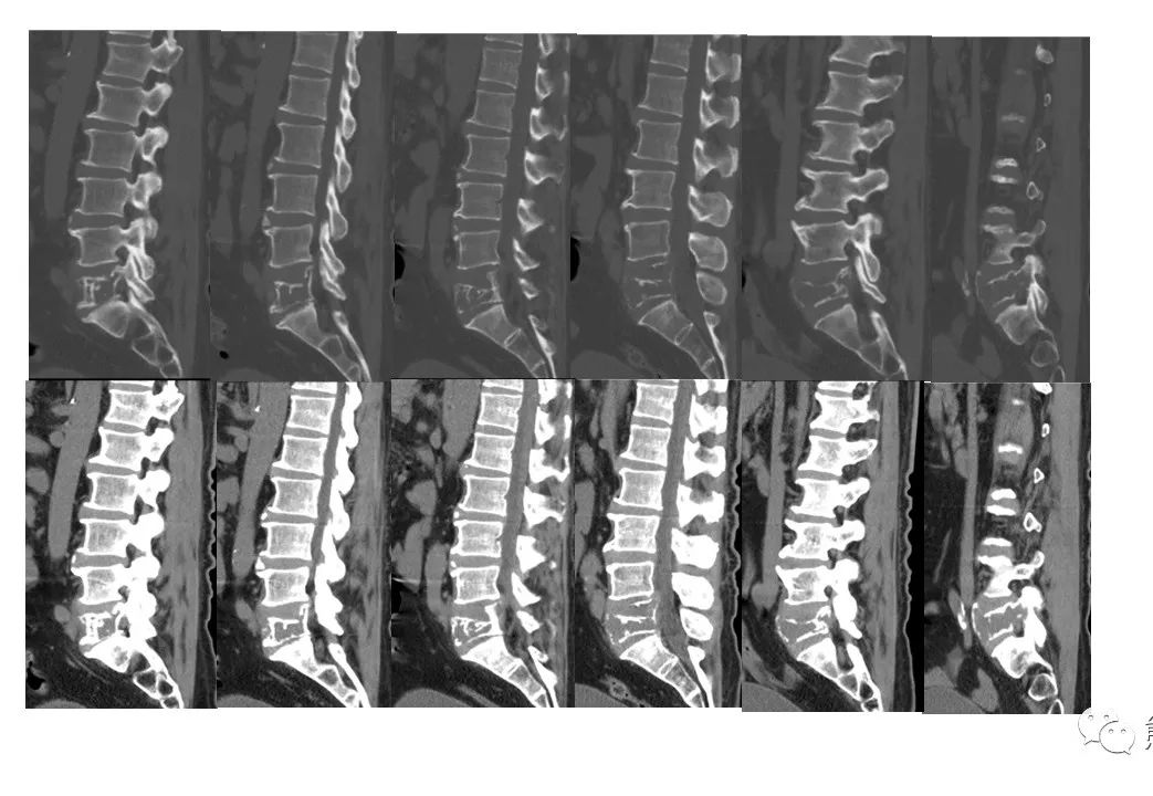 【病例】椎体恶性外周神经鞘瘤 VS 浆细胞瘤-9