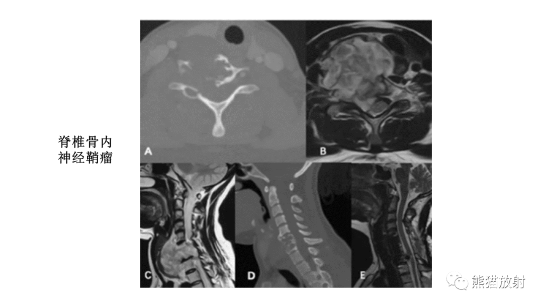 【病例】椎体恶性外周神经鞘瘤 VS 浆细胞瘤-27