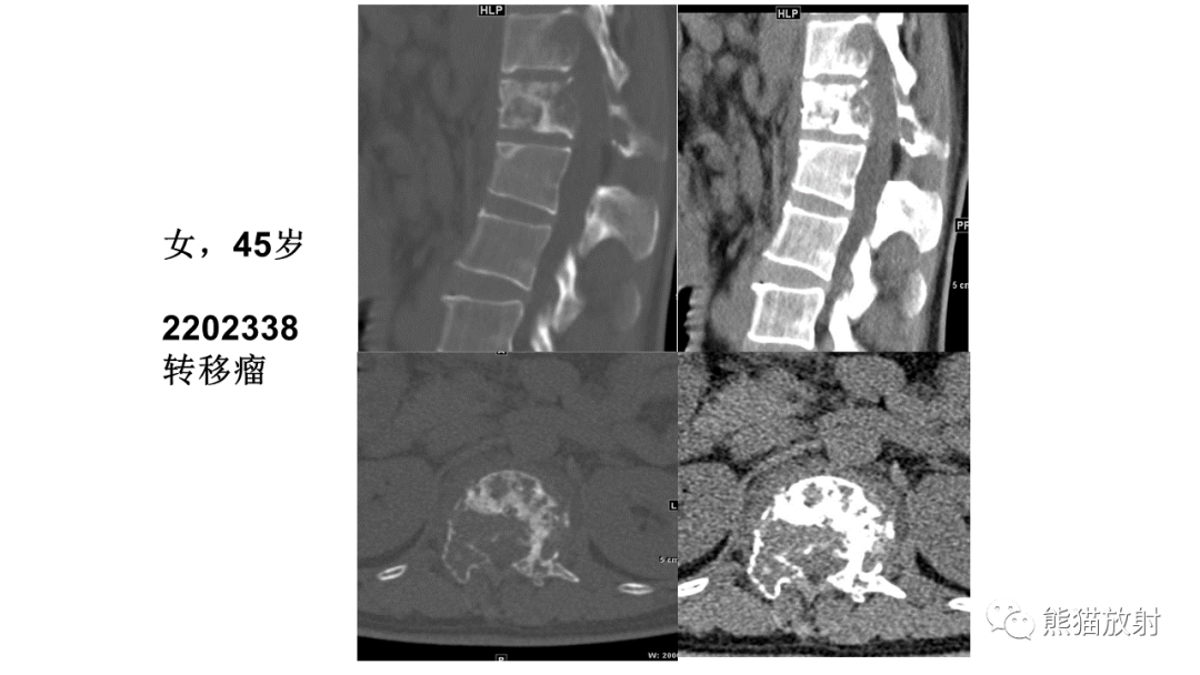【病例】椎体恶性外周神经鞘瘤 VS 浆细胞瘤-29