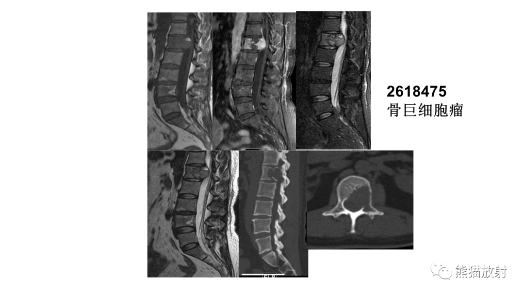 【病例】椎体恶性外周神经鞘瘤 VS 浆细胞瘤-31