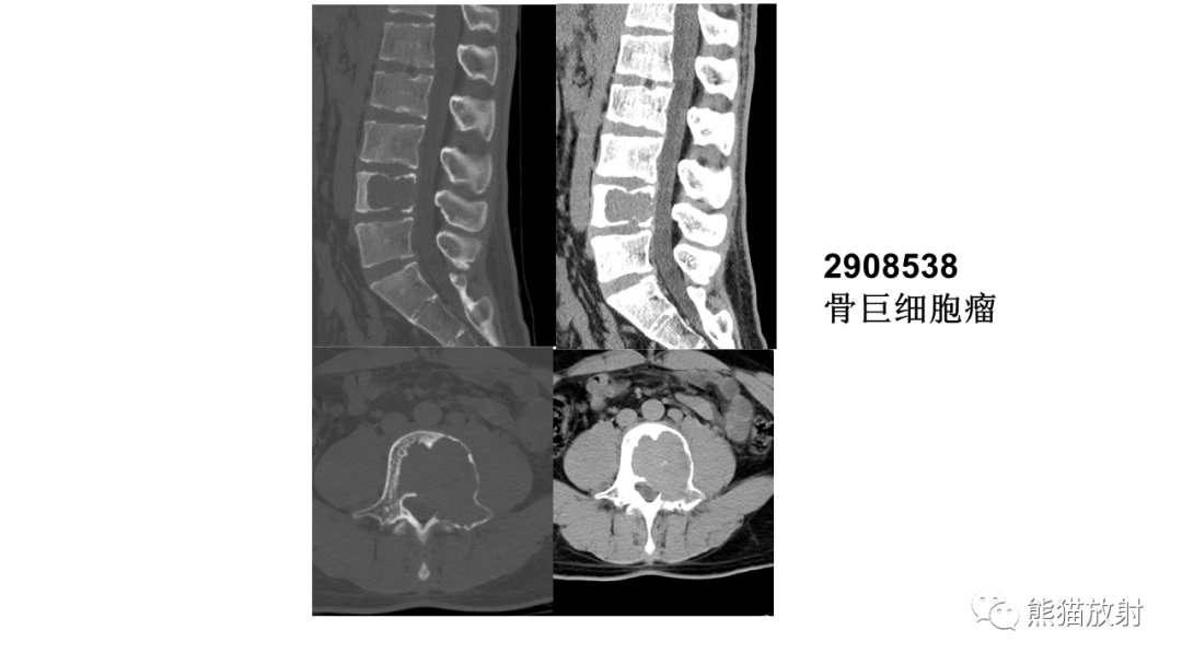 【病例】椎体恶性外周神经鞘瘤 VS 浆细胞瘤-32