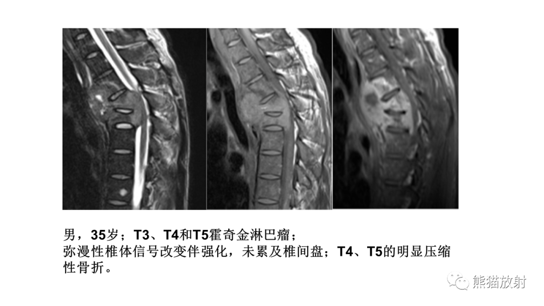 【病例】椎体恶性外周神经鞘瘤 VS 浆细胞瘤-34