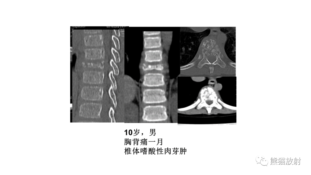 【病例】椎体恶性外周神经鞘瘤 VS 浆细胞瘤-36