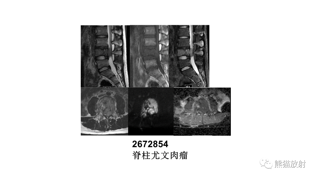 【病例】椎体恶性外周神经鞘瘤 VS 浆细胞瘤-38