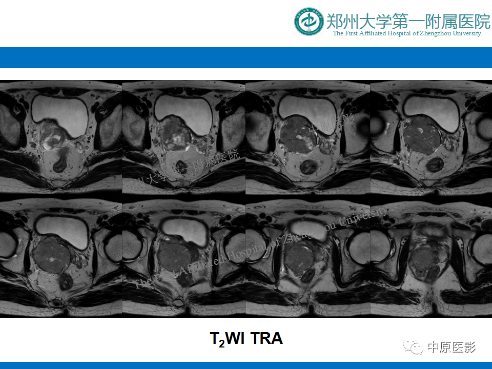 【病例】前列腺滑膜肉瘤1例MR影像-4