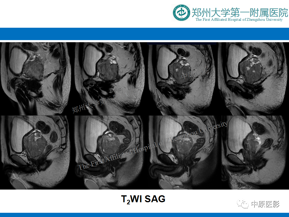 【病例】前列腺滑膜肉瘤1例MR影像-5