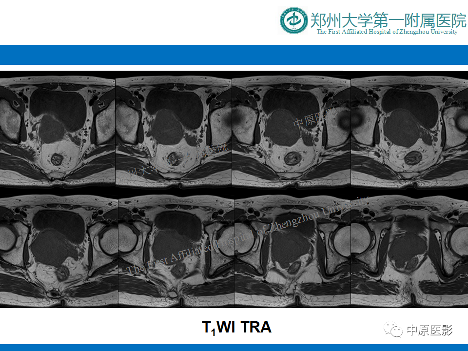 【病例】前列腺滑膜肉瘤1例MR影像-3