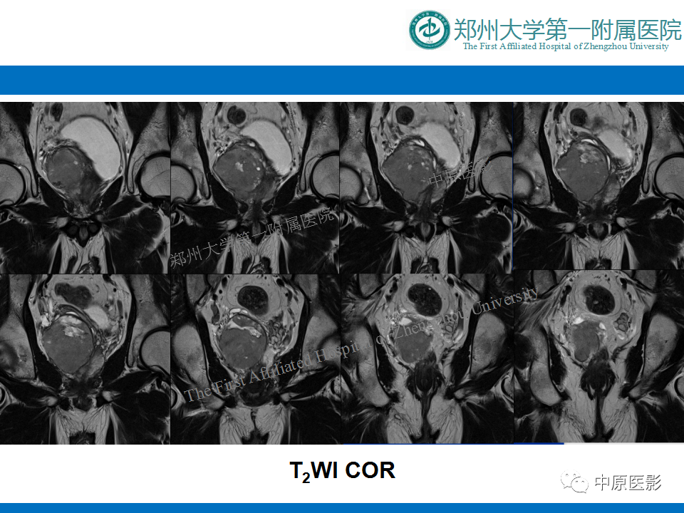 【病例】前列腺滑膜肉瘤1例MR影像-6