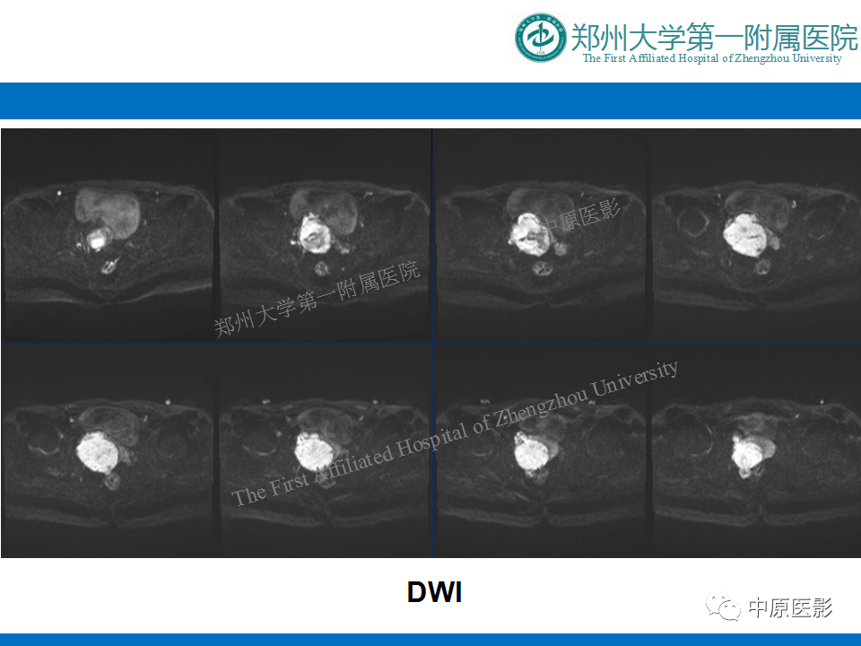 【病例】前列腺滑膜肉瘤1例MR影像-7